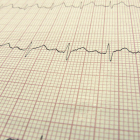 Jak wygląda badanie EKG?